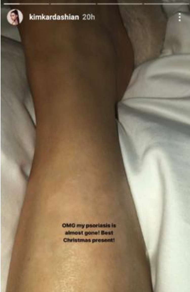 En sus redes sociales en ocasiones comparte los avances de la enfermedad en sus piernas (Foto: Instagram kimkardashian)