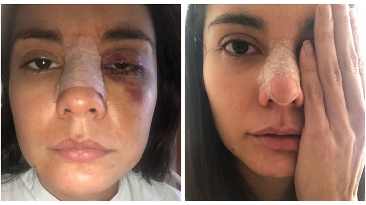 Así quedó la actriz después de ser intervenida en un hospital de México.