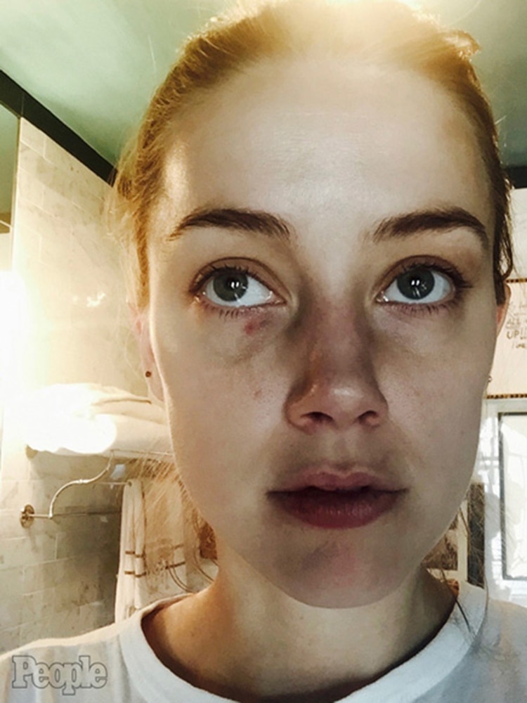 Amber Heard acusó a Johnny Depp de maltrato y mostró su rostro golpeado en la revista People