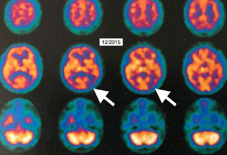Las imágenes de PET muestran las diferencias en el cerebro de la paciente tras el tratamiento con la oxigenoterapia hiperbárica (Louisiana State University)