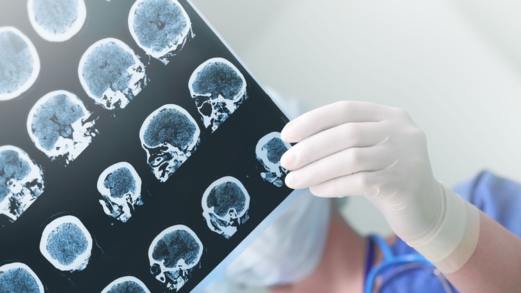 La nueva droga ofrece una esperanza para el deterioro asociado a la vejez, el Alzheimer y la depresión. (Getty)