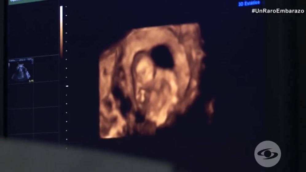 Foto: SÃ³lo se da un caso cada medio millÃ³n de nacimientos en todo el mundo (Foto: YouTube)