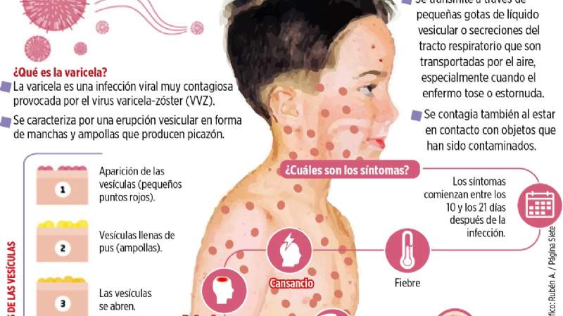 La Paz: hay 375 casos de varicela y la vacuna vale hasta Bs 1.000