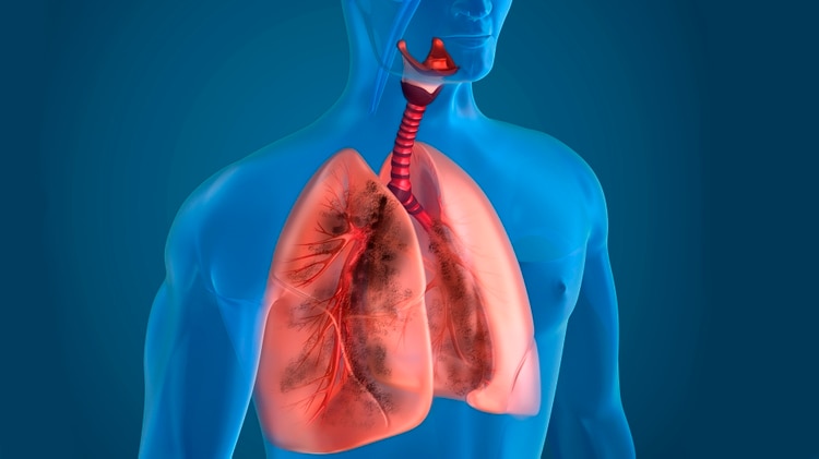 La neumonía es la sexta causa de muerte en general y la quinta causa en mayores de 60 años (IStock)