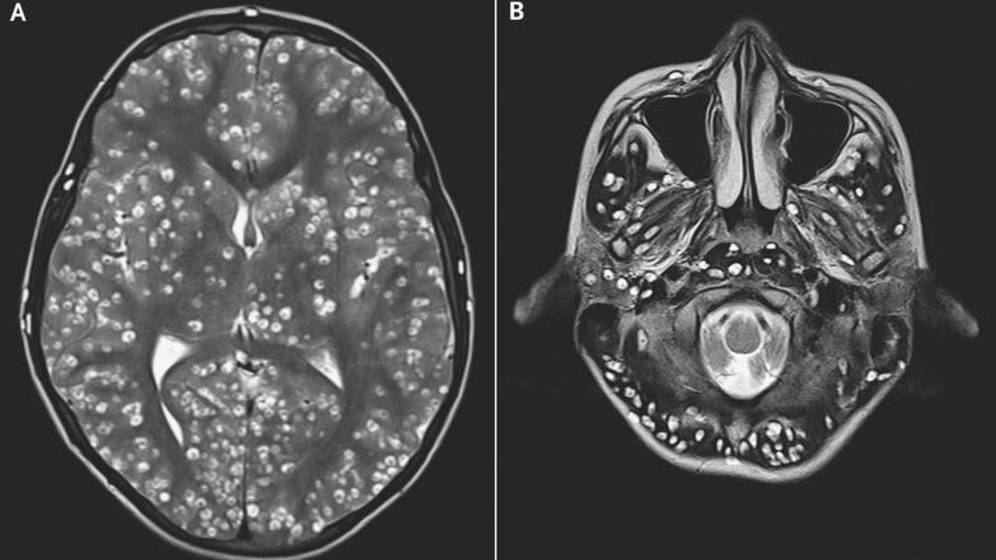 Foto: Resonancia del cerebro (A) y cerebelo (B) del paciente. (Hospital ESIC, Faridabad, India)