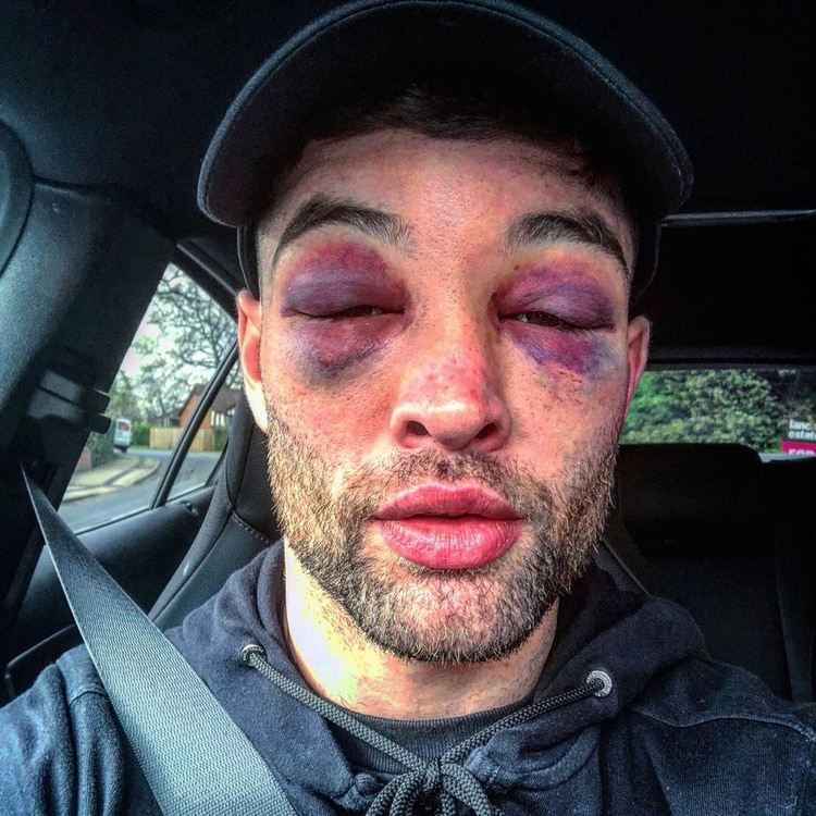 Así quedó el rostro del boxeador británico Scott Fitzgerald tras su pelea ante Anthony Fowler (Twitter: @EddieHearn)