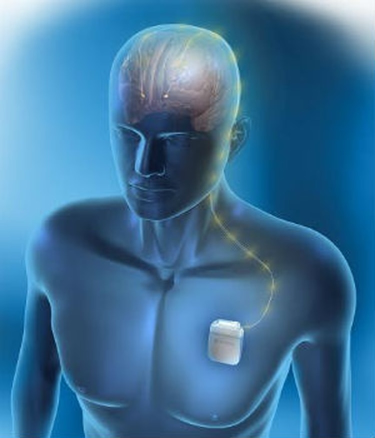 Hay veces que la medicina actua diferente en las distintas etapas de la enfermedad (Foto: Neuroestimulador. Medtronic)