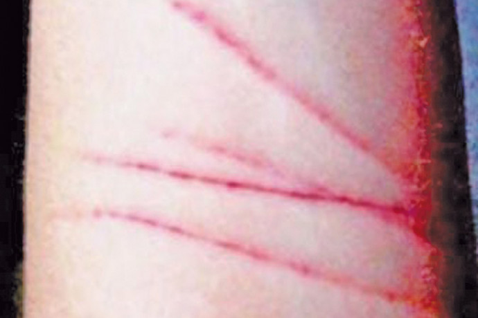 Adolescentes potosinos se hacen tajos en extremidades