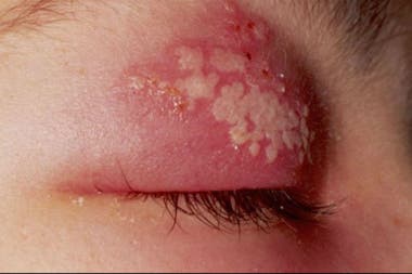 Uno de los primeros síntomas en bebés y niños son ampollas alrededor del ojo
