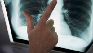 Examen pulmonar mediante placa de rayos X. Foto ilustrativa