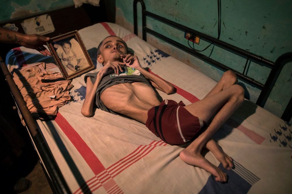 Miguel Blanco nació con hidrocefalia. En la foto, yace en una cama con una imagen suya cuando era bebé en Maracaibo, Venezuela. Ahora tiene 28 años y su madre sólo puede alimentarlo una o dos veces por día (AP)