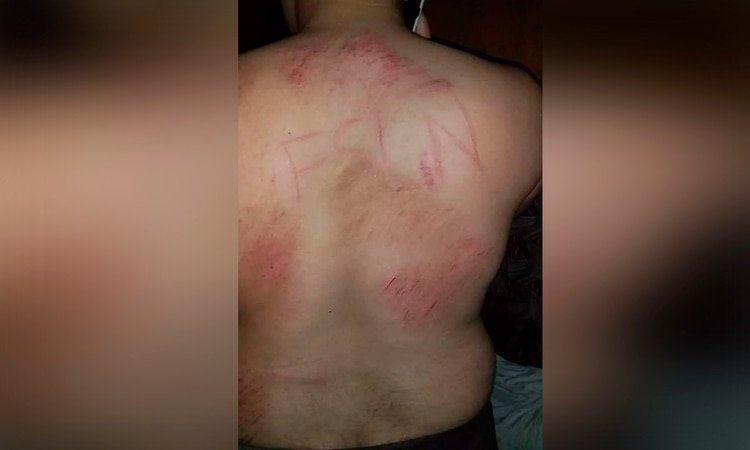 Marcas en la espalda de Leonardo Rivas. (Foto cortesía)