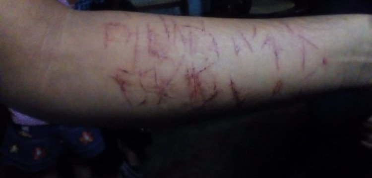 El último caso conocido: marcas en el brazo de un joven de 16 años, de Carazo. (Foto cortesía)