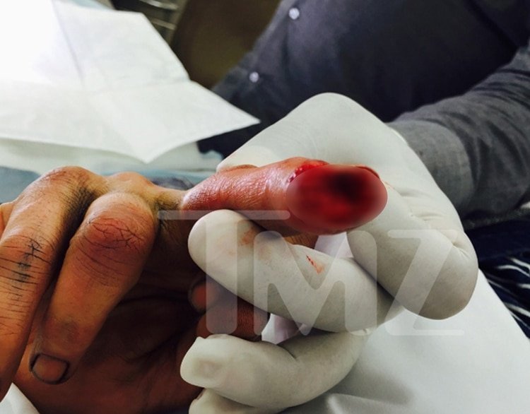 La foto que Johnny Depp filtró a los medios de cómo quedó su dedo tras una pelea con Amber Heard (TMZ)