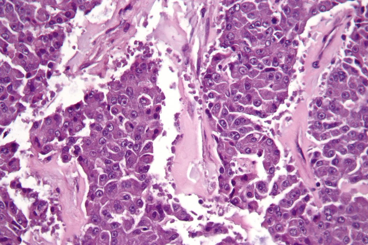 cáncer de páncreas