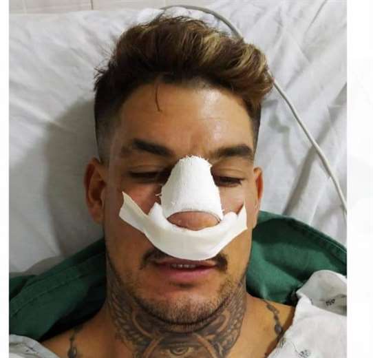 Así quedó Royón luego del cabezazo de Jordy Candia. Foto: Redes