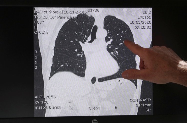 Una imagen de tomografía computada muestra los pulmones de un paciente que padece de COVID-19. (REUTERS/Yves Herman)