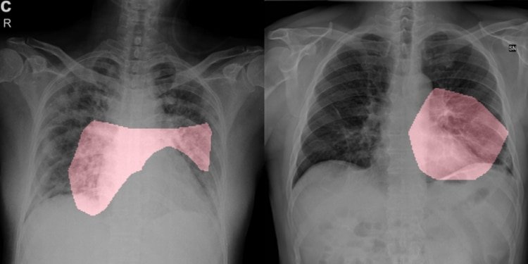 Una de las imágenes del proyecto de IA COVID-Net: las radiografías de tórax de dos personas infectadas con el coronavirus en la que se destacan los factores críticos asociados (GS Inquire/Linda Wang y Alexander Wong)