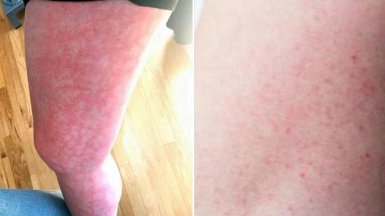 Imágenes de pacientes de COVID-19 con sarpullido en su cuerpo, publicadas por el doctor Randy Jacobs