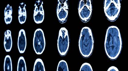 El coronavirus parece causar una coagulación excesiva, por lo cual puede obstruir el flujo de sangre al cerebro y causar un ACV.